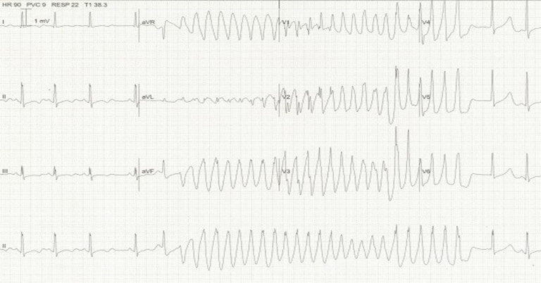Wide/IrregularDDx: Afib with LBBB, Afib with WPW, Torsades or VFDx: Torsades; classic twisting around the isoelectric point