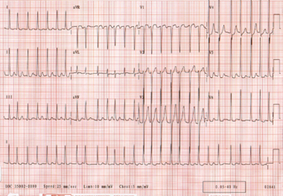 Narrow/IrregularDDx: Afib, Multifocal Atrial Tach (MAT), Aflutter with variable conductionDx: Afib; lack of Pwaves differentiates this from the others