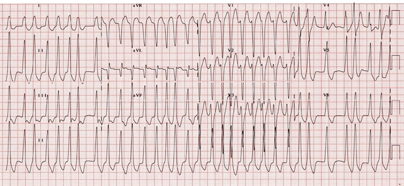 Wide/IrregularDDx: Afib with LBBB, Afib with WPW, Torsades or VFDx: Afib with WPW. One of the fastest rates you'll see, this is a common EM board question. Rate is like 250-300