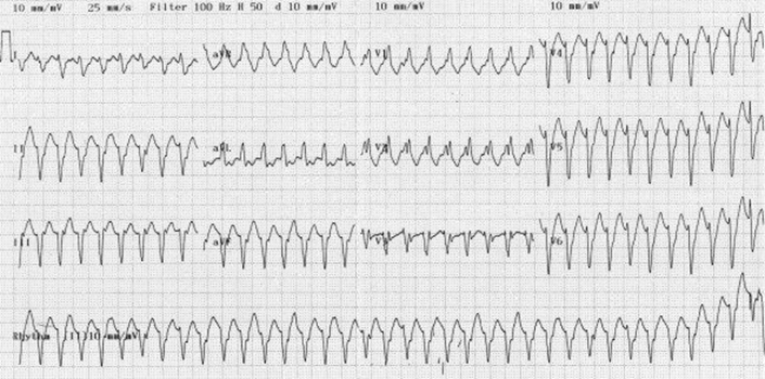 Wide/RegularDDx: Wide/RegularDDx: VT, SVT or ST with aberrant conductionDx: VT; when in doubt treat wide regular as VT unless otherwise proven previous BBB; note the extreme R axis, a giveaway this is VT