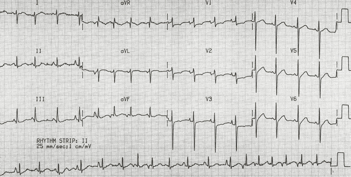 Narrow/IrregularDDx: Afib, Multifocal Atrial Tach (MAT), Aflutter with variable conductionDx: MAT; check out the rhythm strip, multiple different P wave morphologies