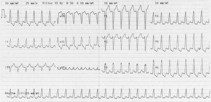 Wide/RegularDDx: VT, SVT or ST with aberrant conductionDx: SVT with BBB; no pwaves; unlike VT, the axis here is normal; after adenosine and cardioversion, the underlying BBB persists confirming the dx