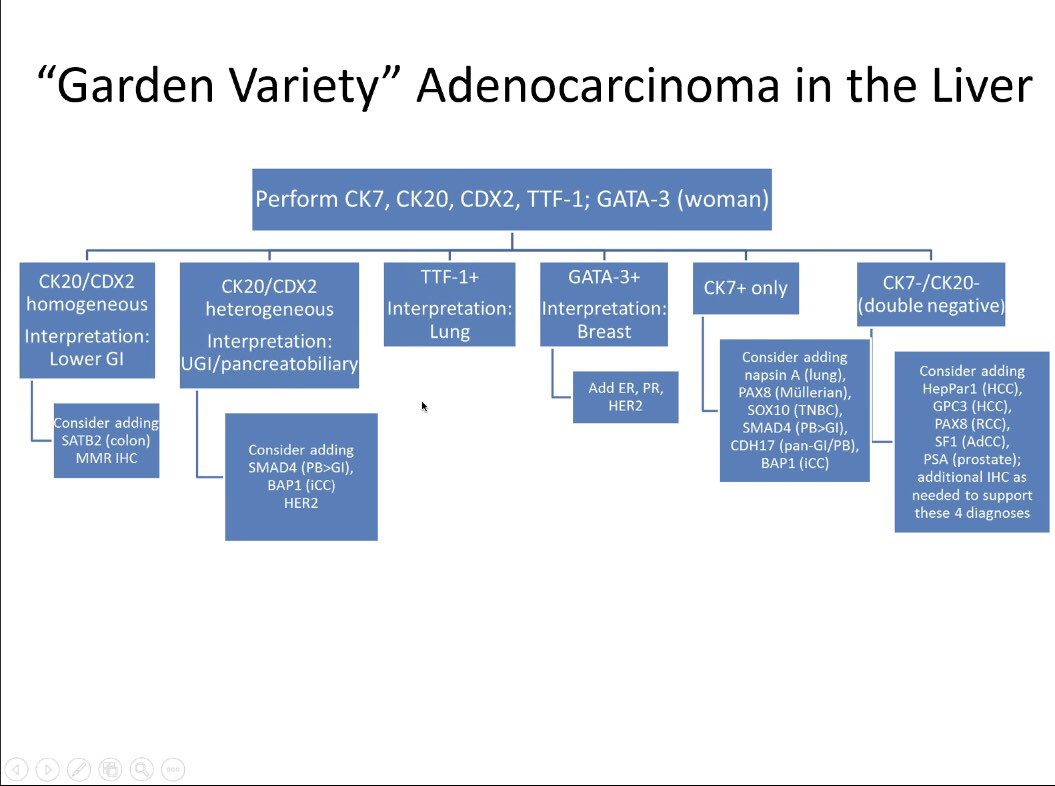 Baskotacytopath's tweet photo. SMAD4 loss not only in Pancreaticobiliary, it can also be seen in GI tract upper and lower though less common. @IHC_guy @ac_pathgal @TheKarenPinto @DrGeeONE #CAPVirtualPath https://t.co/oLOjKBuhvm