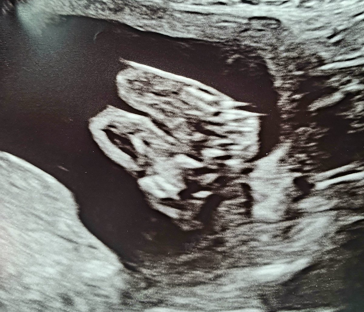 rowenadiamond's tweet image. Little baby tootsies to make you smile 🥰 #20weekscan #baby #feet #ultrasound