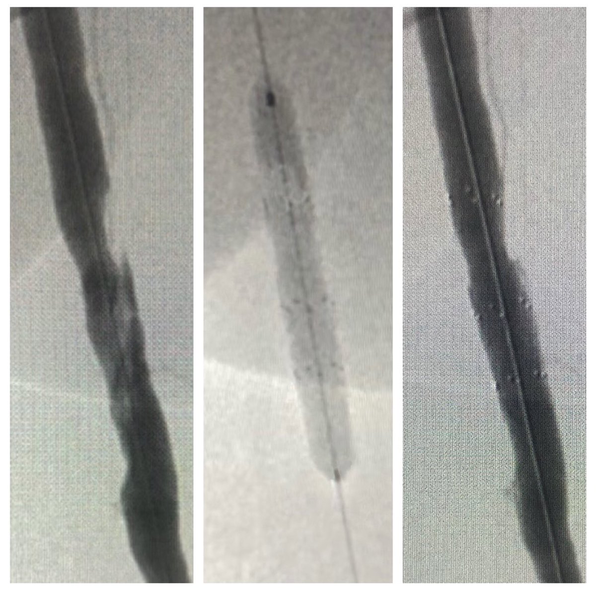 MTV_IR's tweet photo. Make those flow limiting dissections disappear ! Intact Vascular Tack Endovascular System® (6F) #MTVIR #IRad #MIIPs #DissectionsMatter #PAD #CLI #CLIFighters #Vascular #LimbSalvage #Endovascular #IntactVascular @SirSpecialists @SIR_ECS @CLIFighters @CLI_Global https://t.co/Zhq3cbivPR