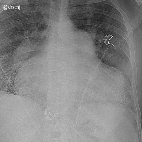 39yo♂️. Chest Pain. I don't have any better history. But what a CXR!