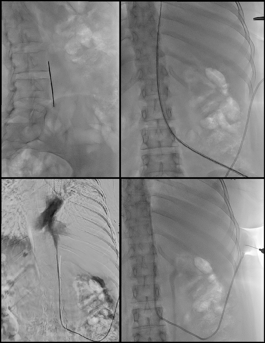 raydiologist's tweet photo. Trans-lumbar port today @Sunnybrook  

@RPugash #IRad #oldschool https://t.co/m3N3GprHmc