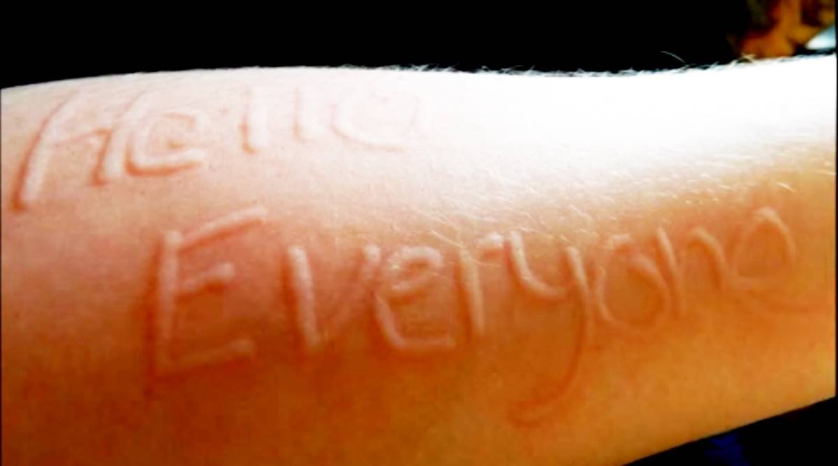 ach_tu's tweet photo. Are you one of the roughly 5% of the population that can "write" on your skin? You may have dermatographia, the most common form of physical urticaria. Read More: https://t.co/qz6Pi3sm9c https://t.co/RIgka4qJB9