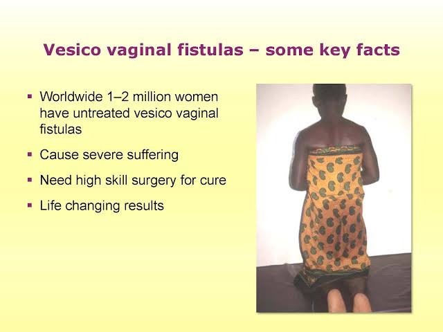 Most women who develop fistula usually caused by prolonged, obstructed labour, remain untreated for their entire lives, and the condition can easily recur in women and girls whose fistula has been surgically treated but who receive little or no medical care  #EndFistula