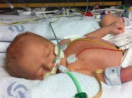 Entre otras cosas, un aporte fundamental de estos ventiladores para bebés, fue dotarles con un mezclador de oxígeno/aire para controlar la toxicidad del oxígeno que podía causar ceguera u otros problemas graves en los pequeños, incluida su muerte