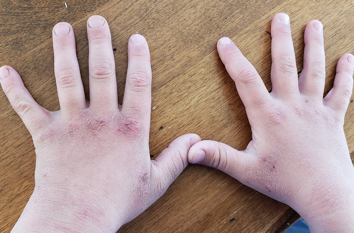 Lavage des mains à l'école.... lavez-vous les mains... Ben oui quand c'est rendu que le soir il pleure pcq ça craque tellement c'est sec pi que ça fait mal... trop c'est comme pas assez....