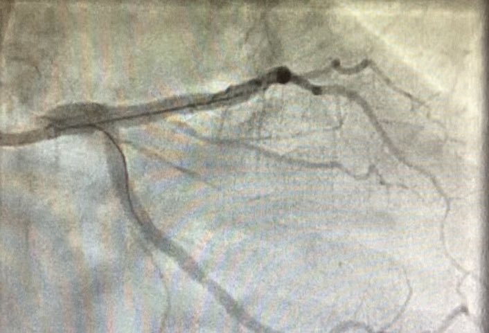 Billal72073638's tweet photo. Ultra low contrast PCI. LMS DK crush + mid LAD with syncvison IVUS co-registration 5ml contrast used at the end. @PCRonline @drtrc99 @HeshamKAbdelaz1 @philipalanlang #cardiotwitter #renalprotection https://t.co/8bNJTQs2Zd