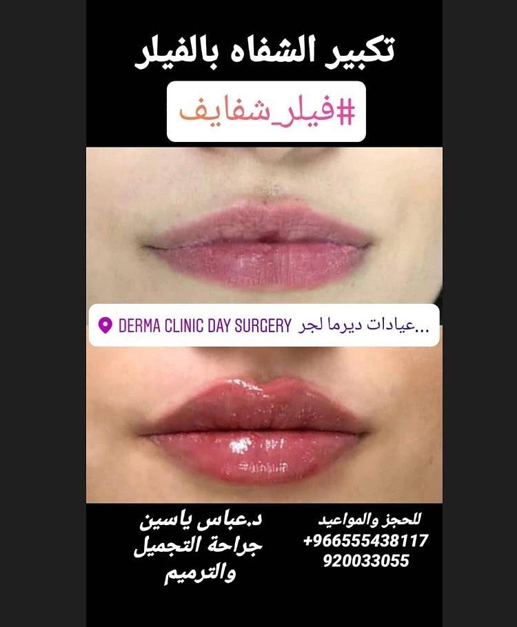 Derma_surgery's tweet photo. #عيادات_ديرما #تجميل #جراحات #بوتوكس #فيلر #بلازما #تكبير_رفع_تصغيير_الصدر #غمازة #ذقن_مزدوج #تجميل_الانف #صحة #رشاقة https://t.co/gKrEBS0Qcm
