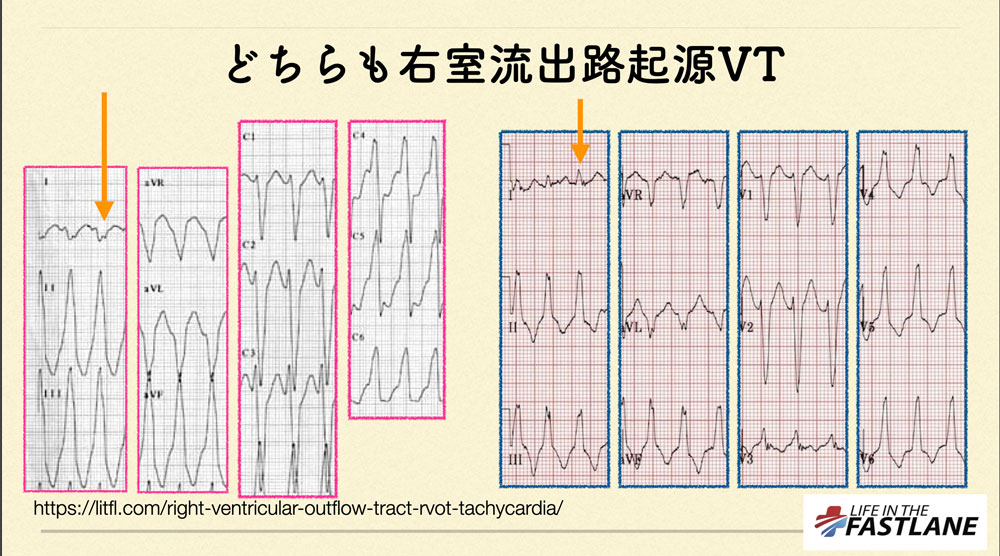 N Tsukishima 心電図検定試験対策 始めました Pa Twitter 心電図検定試験 Q 6 Answer 16 このvt時の I 誘導の波形を見て下さい どこ起源かをi 誘導の波形から推定するのは 無理ゲーです 12誘導の波形を総合して Vtのoriginを考えます T Co Ljevjmxkag