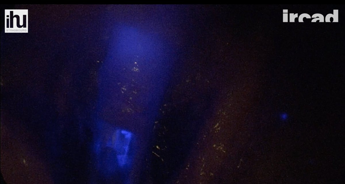 Colorectal Disease (@colorectaldis) on Twitter photo A novel method for near‐infrared fluorescence imaging of the urethra during perineal and transanal surgery
<a href="/MIC_DIANA_IRCAD/">Michele Diana IRCAD</a> <a href="/IrcadFrance/">IrcadFrance</a>
#colorectalresearch #colorectalsurgery #ICG
onlinelibrary.wiley.com/doi/abs/10.111… A novel method for near‐infrared fluorescence imaging of the urethra during perineal and transanal surgery
<a href="/MIC_DIANA_IRCAD/">Michele Diana IRCAD</a> <a href="/IrcadFrance/">IrcadFrance</a>
#colorectalresearch #colorectalsurgery #ICG
onlinelibrary.wiley.com/doi/abs/10.111…