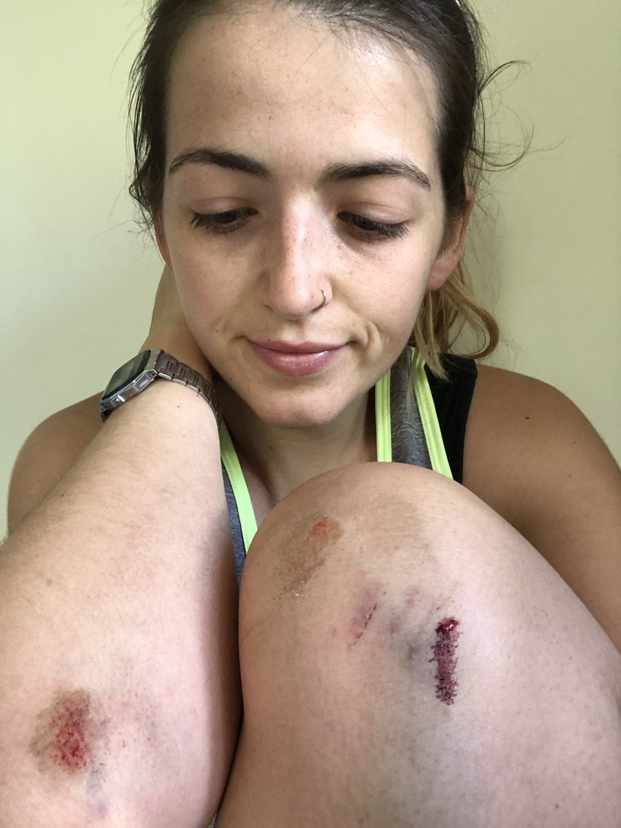 hannahdingbrown's tweet photo. 2km from home I tripped on curb and cut my knees and elbow #classichannah https://t.co/O2sRhX73Kc