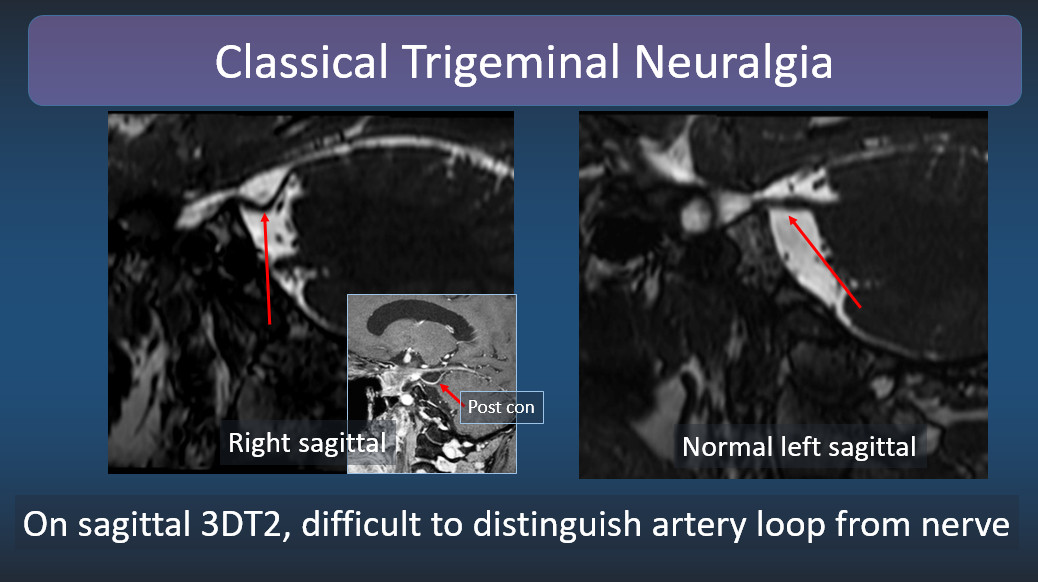 We see so many normal studies for trigeminal neuralgia, nice to be reminded of what abnormal looks like. Trigeminal neuralgia is categorized: 
-Classical (defined by typical symptoms and MRI evidence of vascular compression) 
-Idiopathic 
-Secondary (tumor, MS, PNTS)