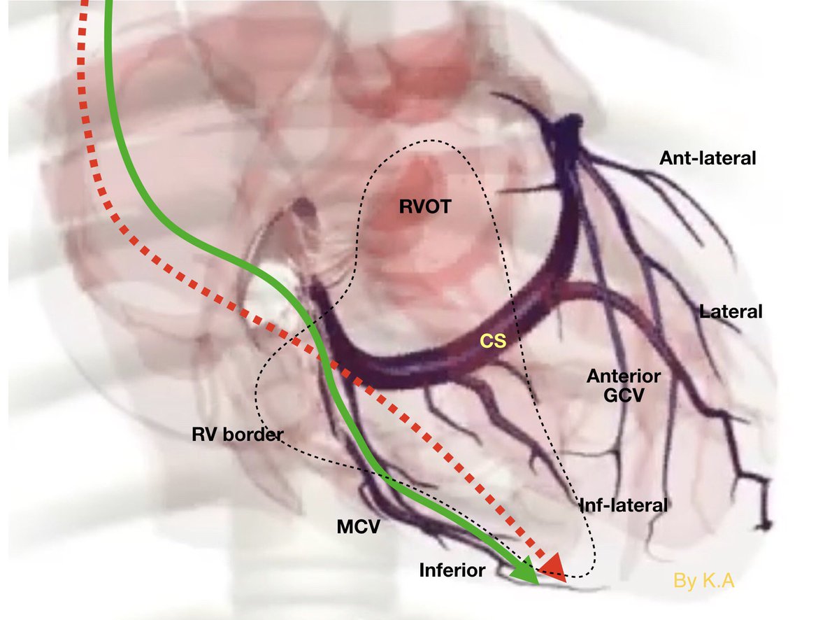 Great diagrams to show typical positions of RV pacing lead on CXR (first 2 pics) and during implantation (PA and LAO)

Black RV apex
Blue Middle cardiac vein
Yellow RVOT
Red lateral branch of CS

Enjoy

PS diagrams created by me. Feel free to use pics for education