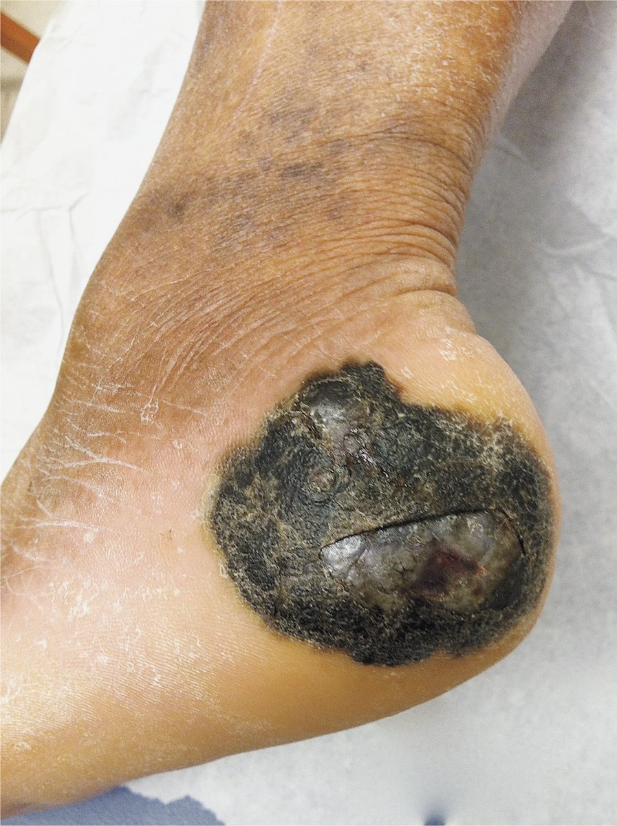  #Acral lentiginous melanoma appears in the palms of the hands, soles of the feet and under the nails. Its diagnosis can be complicated because it can be mistaken for fungal infections, warts, diabetic foot ulcers or traumatic ulcers (2/15) (pic from DOI: 10.1056/NEJMicm1500906)
