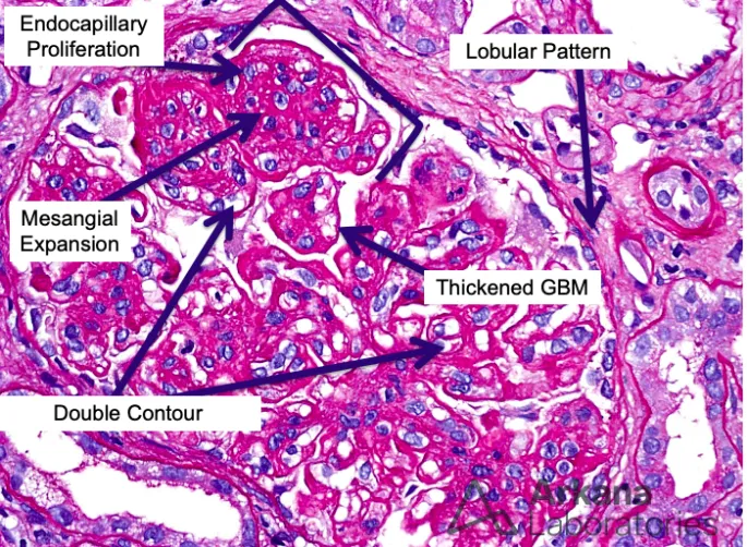 Neph_SIM's tweet photo. 🚨 New Case Alert 🚨

A 33 y/o with microscopic hematuria &amp; hypocomplementemia...

https://t.co/DUcpI5nR9y

Our mnemonic for ⬇️ complement #kidney diseases: CHAMPS 🏆

C-ryo
H-eavy chain DD
A-theroembolic dz
M-PGN
P-IGN
S-LE nephritis 

#FOAMed #KidneyPath #CHAMPS https://t.co/jrWl2BpngI