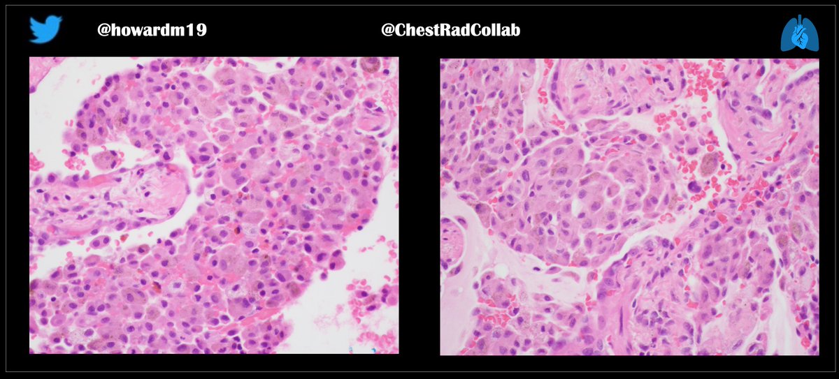chestradcollab's tweet photo. @smlungpathguy @6Patterns @JeffreyKanneMD @yro854

A 60-year-old female with a chronic respiratory illness. A surgical lung biopsy was performed. History withheld.

(See all three images below).

Diagnosis ?

#ChestRadEd  #FOAMrad https://t.co/WaYhKSCNnQ