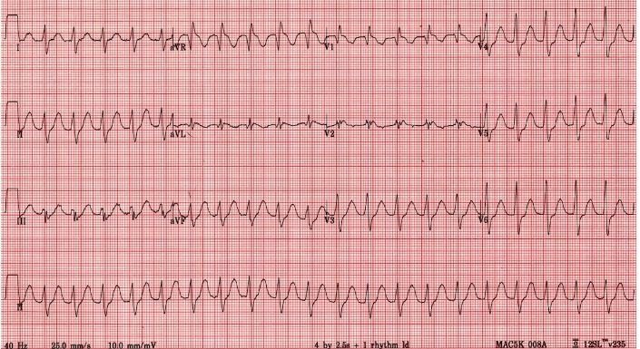 #MedStudentTwitter : Anyone want to take a stab at this case? 24 yo history of seizures on multiple antiepileptic drugs and psych drugs found after a questionable OD in status epilepticus. Intermittent sz with postictal periods but never returning to baseline before sz again