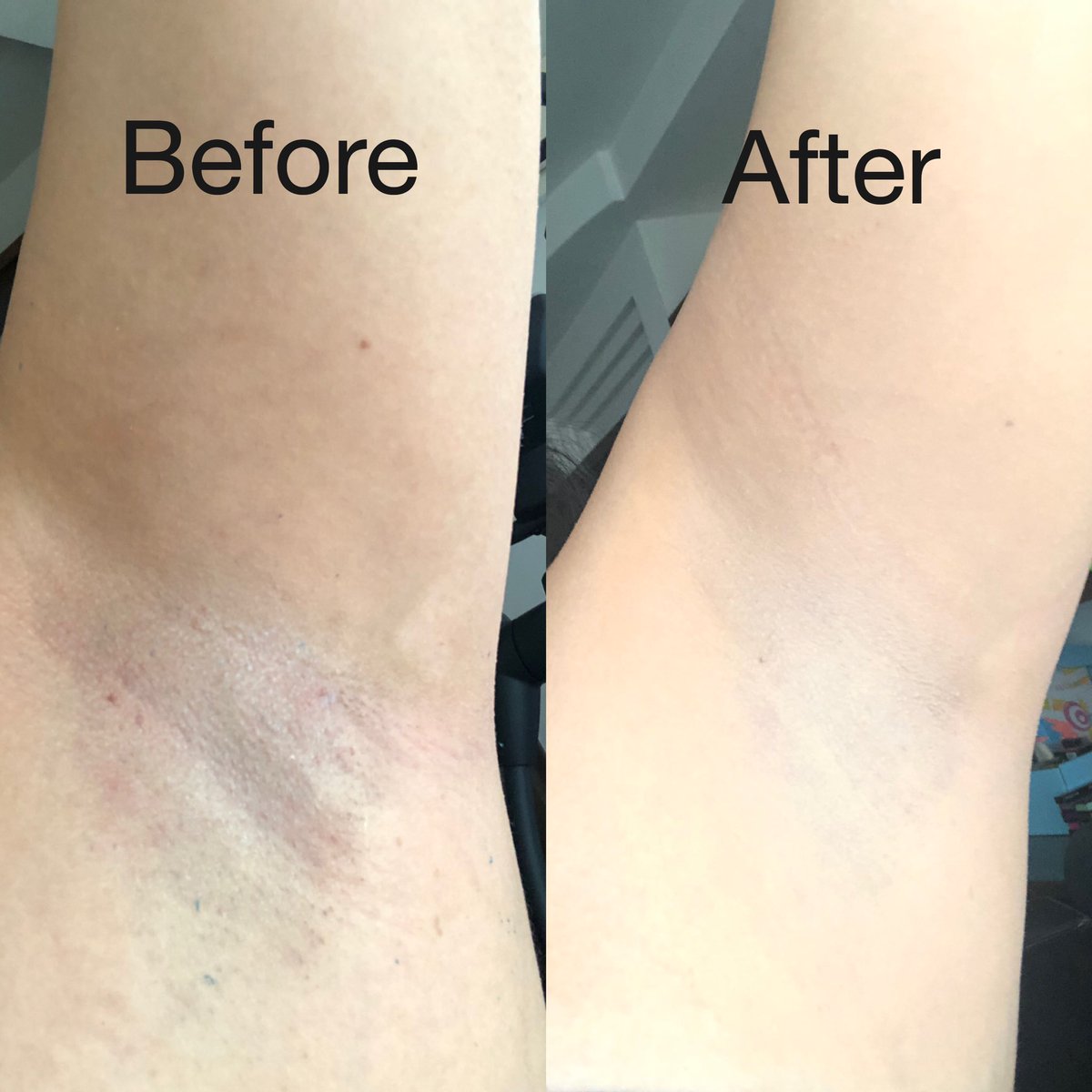 fitfashionistap's tweet photo. Never Shave Again! 🥰

🎁 HUGE SALE 57% OFF + Free Shipping!
🎉Sale Ends Soon🎉
👉 Stops hair re-growth on any body part.
90-day money-back guarantee.
👉 500+ verified 5-star reviews.
👉 One time purchase, no extra costs.

Order From: 👉🏻https://t.co/zAUG8kXN7O. https://t.co/Xu1WDw84PE