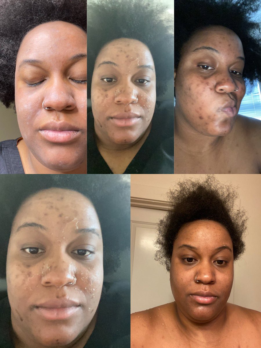 Two weeks ago vs. Today. My skincare regimen was already working but the chemical peel pushed me over. My skin bout to be my BIGGEST flex!