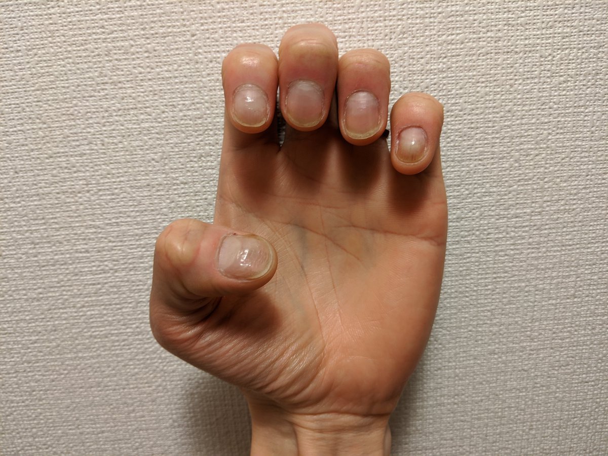 爪噛み男 Nail Biter 85日目 無傷 忙しくする イフゼンプランニング 100日まで15日 Day 85 No Damage Making Yourself Busy And If Then Planning 15 Days To Go 爪噛み克服 深爪矯正 Stopnailbiting T Co Qhoad8elaq