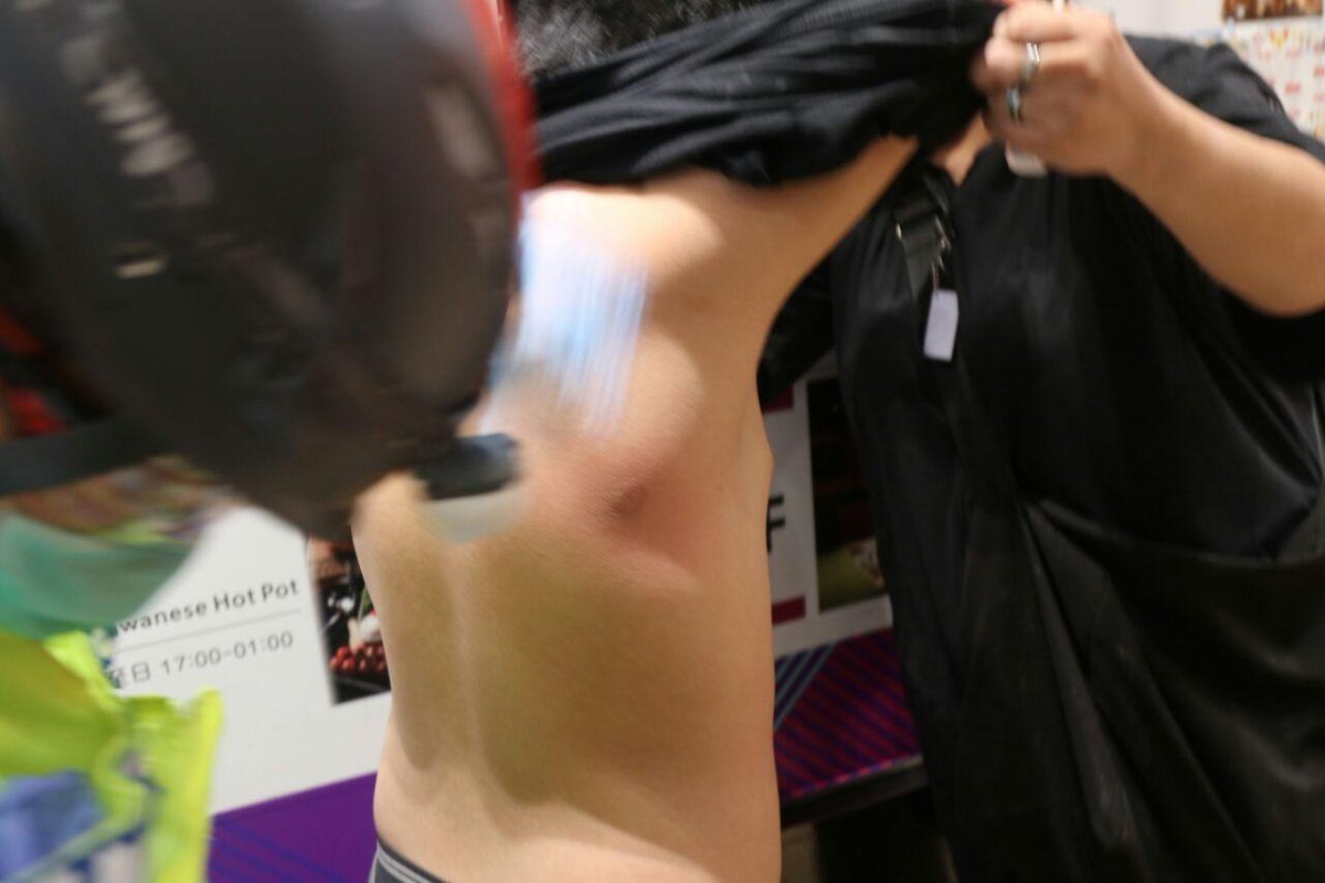 Hong Kong Free Press Hkfp A Boy Appeared To Have Sustained An Injury To His Back After Being Hit By A Police Projectile Photo Joshua Kwan United Social Press T Co Z4vwzzmozt