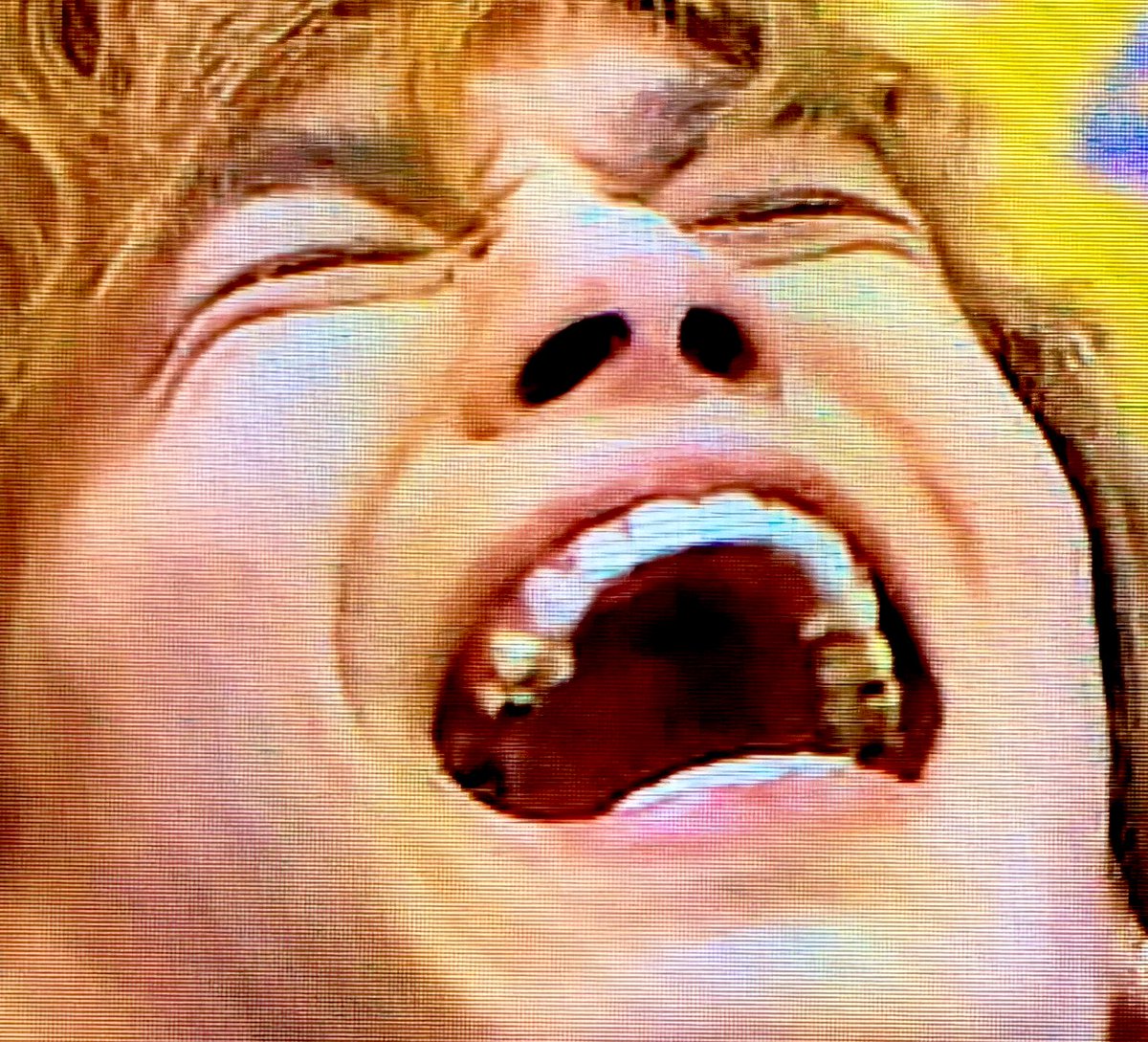 キスマイ歯担 清少納言 千ちゃん 整形疑惑とか言われとるけど歯 抜いたせいっていう意見もあってなるほど 親知らずは全部抜いたんかインプラント のせいか 歯 の治療のせいであって欲しい 懐かしい千ちゃんの銀歯ぁ 萌える 千賀