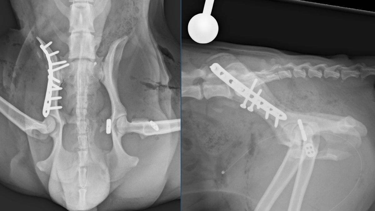 Ilial body fracture: very unstable, weight-bearing axis disrupted. Very oblique so as well as usual lateral plate (in this case 2.7 LCP) ideal for 2.7 V-D lags screws which make for a pretty strong repair #orthotwitter