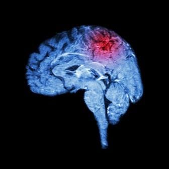 Università Vita-Salute San Raffaele (@myunisr) on Twitter photo A group of <a href="/MyUniSR/">Università Vita-Salute San Raffaele</a> and <a href="/SanRaffaeleMI/">Ospedale San Raffaele</a> researchers authored a #review on <a href="/_JCBFM/">JCBFM</a> providing an overview of the current knowledge and expanding #research relating to #thrombus composition analysis in large vessel occlusions ⬇️ buff.ly/3eShWaD <a href="/marcobacig/">marco</a> <a href="/semerano_aurora/">Aurora Semerano</a> A group of <a href="/MyUniSR/">Università Vita-Salute San Raffaele</a> and <a href="/SanRaffaeleMI/">Ospedale San Raffaele</a> researchers authored a #review on <a href="/_JCBFM/">JCBFM</a> providing an overview of the current knowledge and expanding #research relating to #thrombus composition analysis in large vessel occlusions ⬇️ buff.ly/3eShWaD <a href="/marcobacig/">marco</a> <a href="/semerano_aurora/">Aurora Semerano</a>