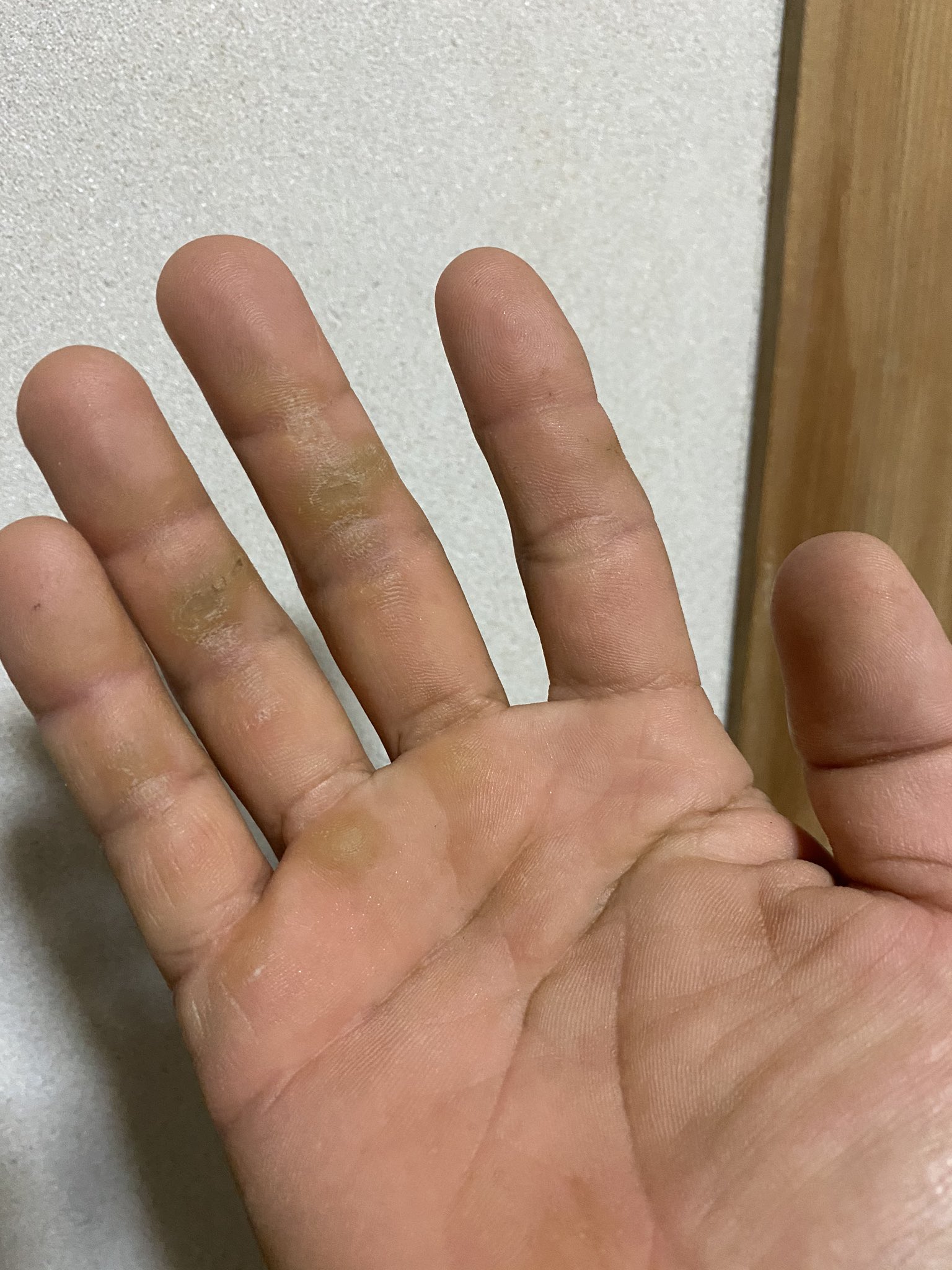 岩ちゃん Spookies0802 Tae Aduki 虫刺されか漆 ハゼ みたいな植物によるかぶれかな 見た目は火傷に見えますねー 私の手はマメだらけですがw T Co 0eft4ivcao Twitter