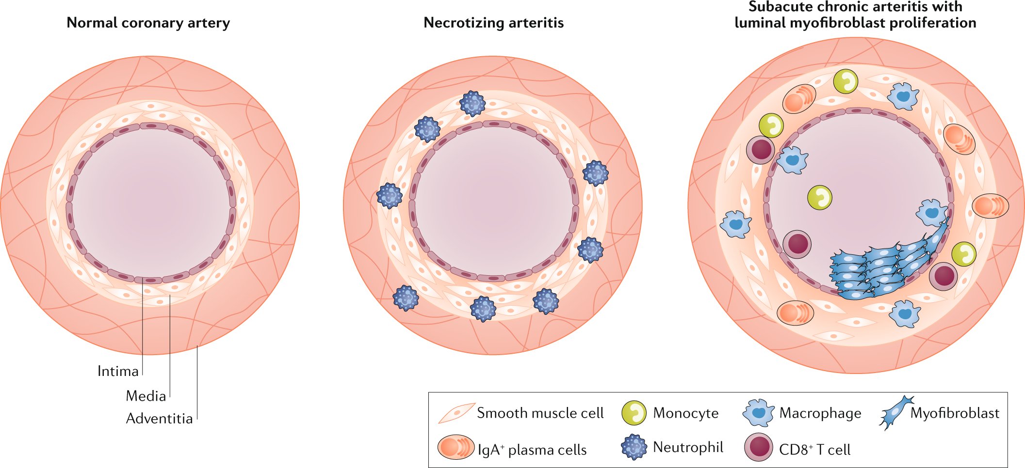 kawasaki arteritis