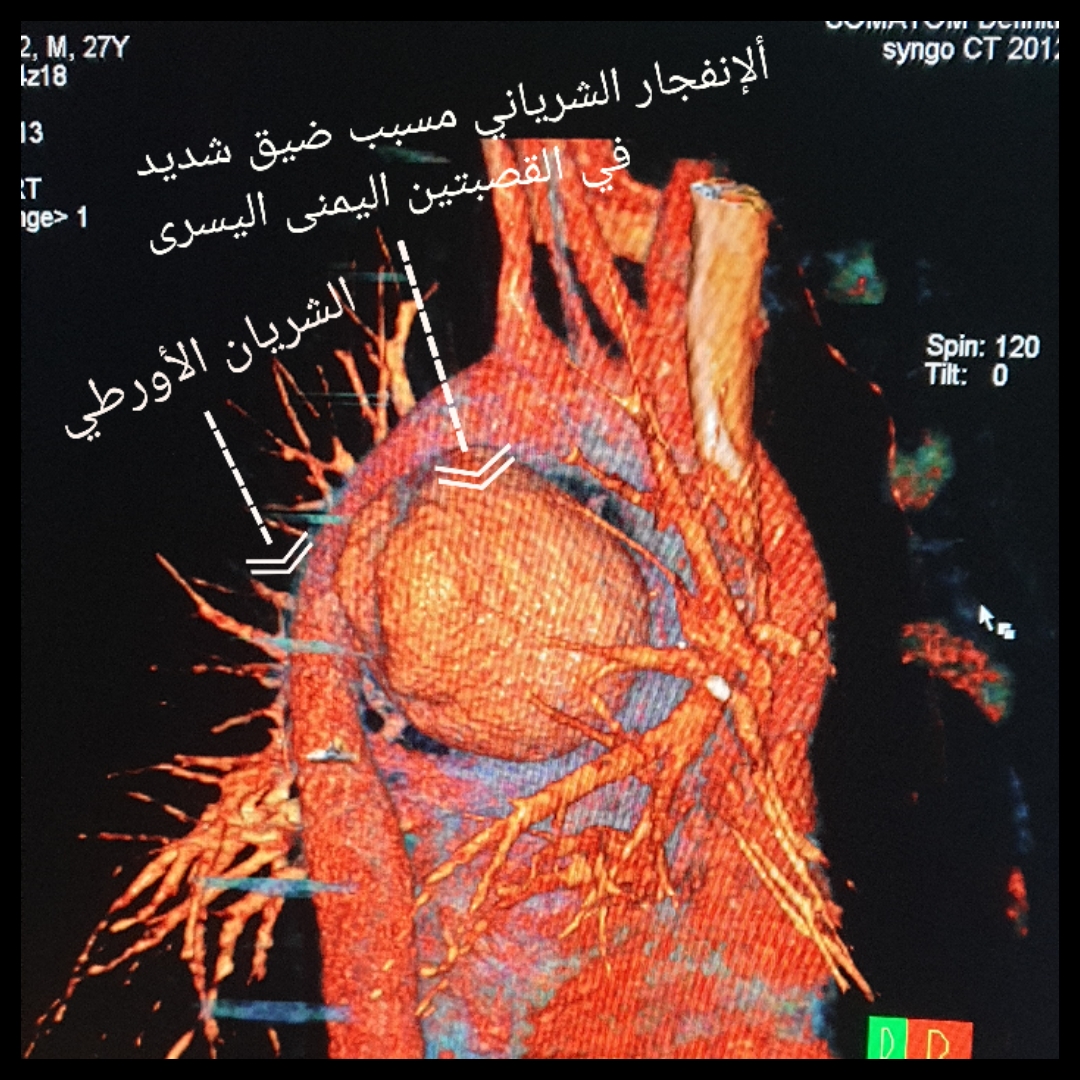 algarni3000's tweet photo. الحمدلله على توفيقه🙏
للتو انتهينا في @KAMC_MAKKAH  من عمل قسطره عاجله للتحكم بالشريان الأورطي المنفجر و إنقاذ حياة مريض عشريني محول من مستشفى ب #جدة.
من الحالات النادره على مستوى #العالم بحكم العمر و إحتياجنا لتحضير جهاز  ECMO (الرئه الصناعيه)

#السعودية #صحه #مكه_الان https://t.co/4LVz5WfsfT
