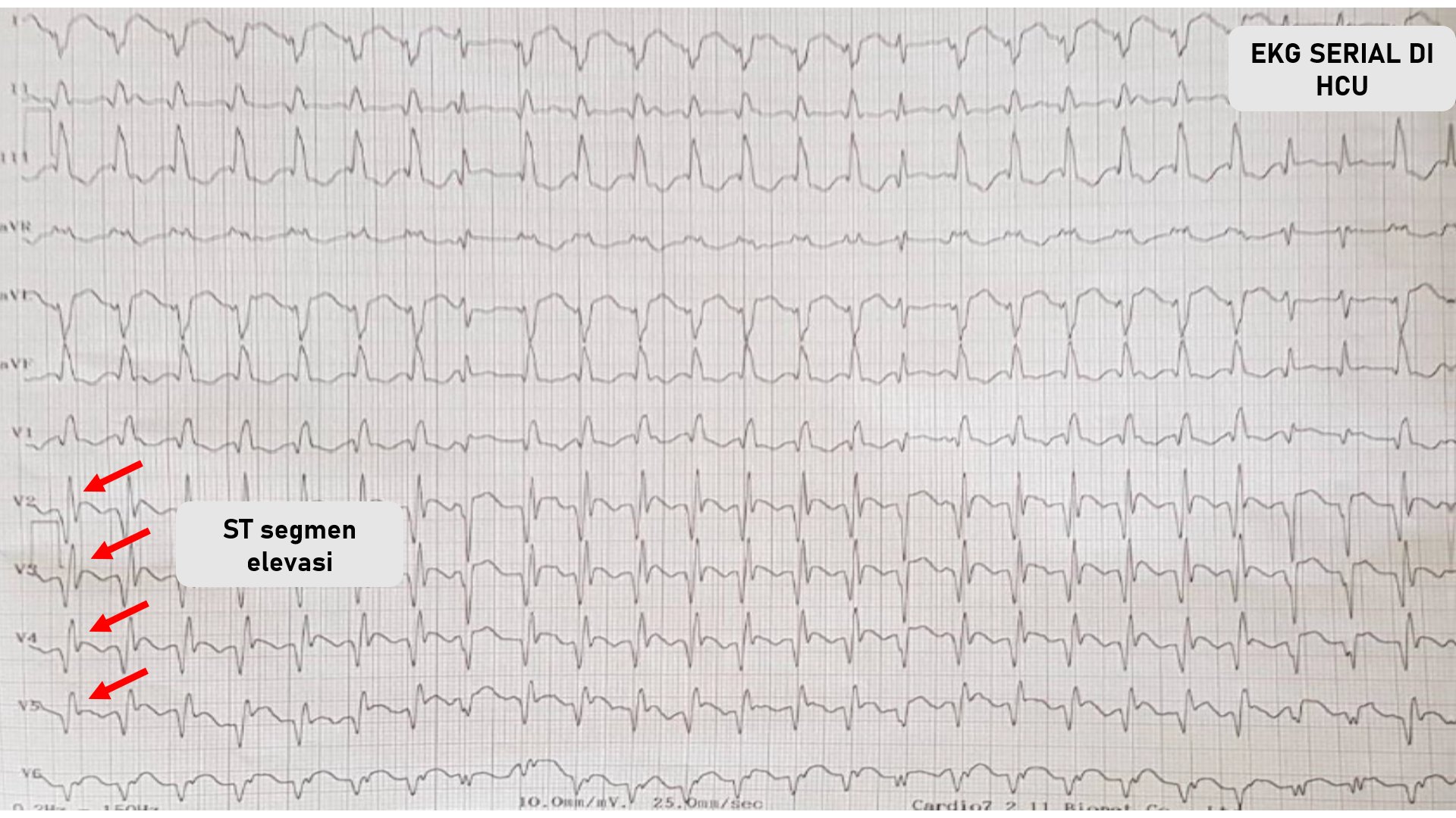 Kurniawan Prakoso On Twitter Nah Misalnya Kalian Dapet 2 Ekg Yang Berbeda Kayak Gini Https T Co Wdtjrxk715 Twitter