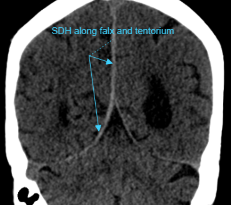 mdneurorads's tweet photo. Answer to 6/5 case:
Acute subdural hematoma along the falx and tentorium
Full scrollable DICOM case via @pacsbin
CT: https://t.co/XJNkatZJV7
Case from @SivaGaddam
#Radres #Neuroradiology #FOAMrad #FOAMed #NeuroRad #radiology #Radfellow #Traumarad #Trauma #MedTwitter https://t.co/8yMxFMWRVi