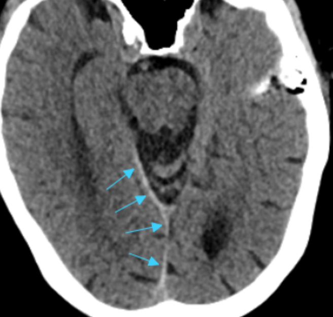 mdneurorads's tweet photo. Answer to 6/5 case:
Acute subdural hematoma along the falx and tentorium
Full scrollable DICOM case via @pacsbin
CT: https://t.co/XJNkatZJV7
Case from @SivaGaddam
#Radres #Neuroradiology #FOAMrad #FOAMed #NeuroRad #radiology #Radfellow #Traumarad #Trauma #MedTwitter https://t.co/8yMxFMWRVi