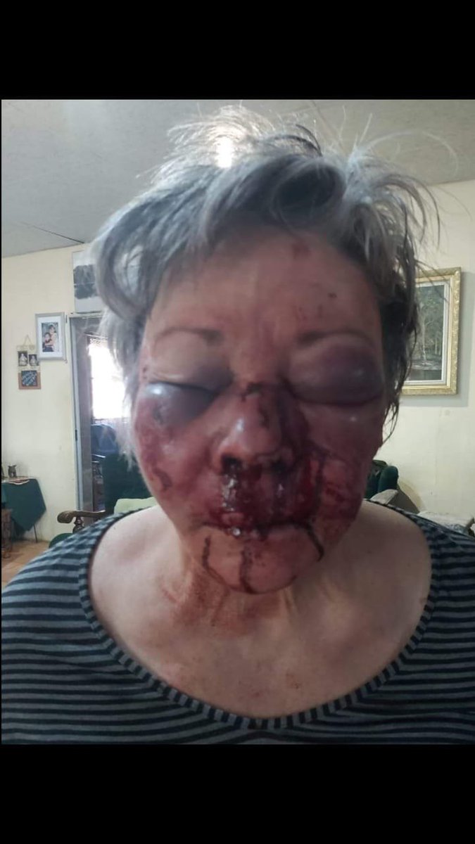 Farm Attack 6/6/20: Reivilo, North West: Elderly couple brutally attacked. Kettle filled with boiling water poured over male victims back. This is what the lady looked like after attack.

#WhiteLivesMatters