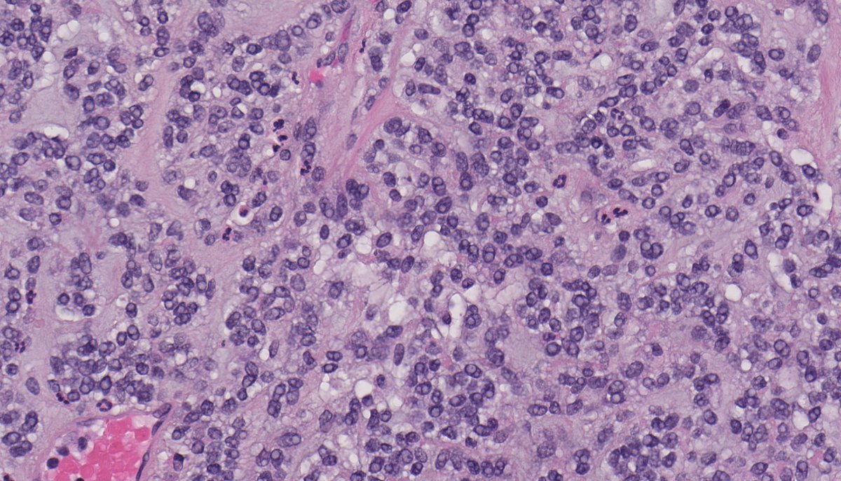 EWSR1-NFATC2—associated sarcoma. NB: a very rare neoplasm, predominating in bone; anatomizing cords-to-sheets of small-to-medium cells; abundant myxohyaline stroma; RNA-seq useful in differentiating from potential mimics (Ewing sarcoma, myoepithelial tumour, &amp;c).