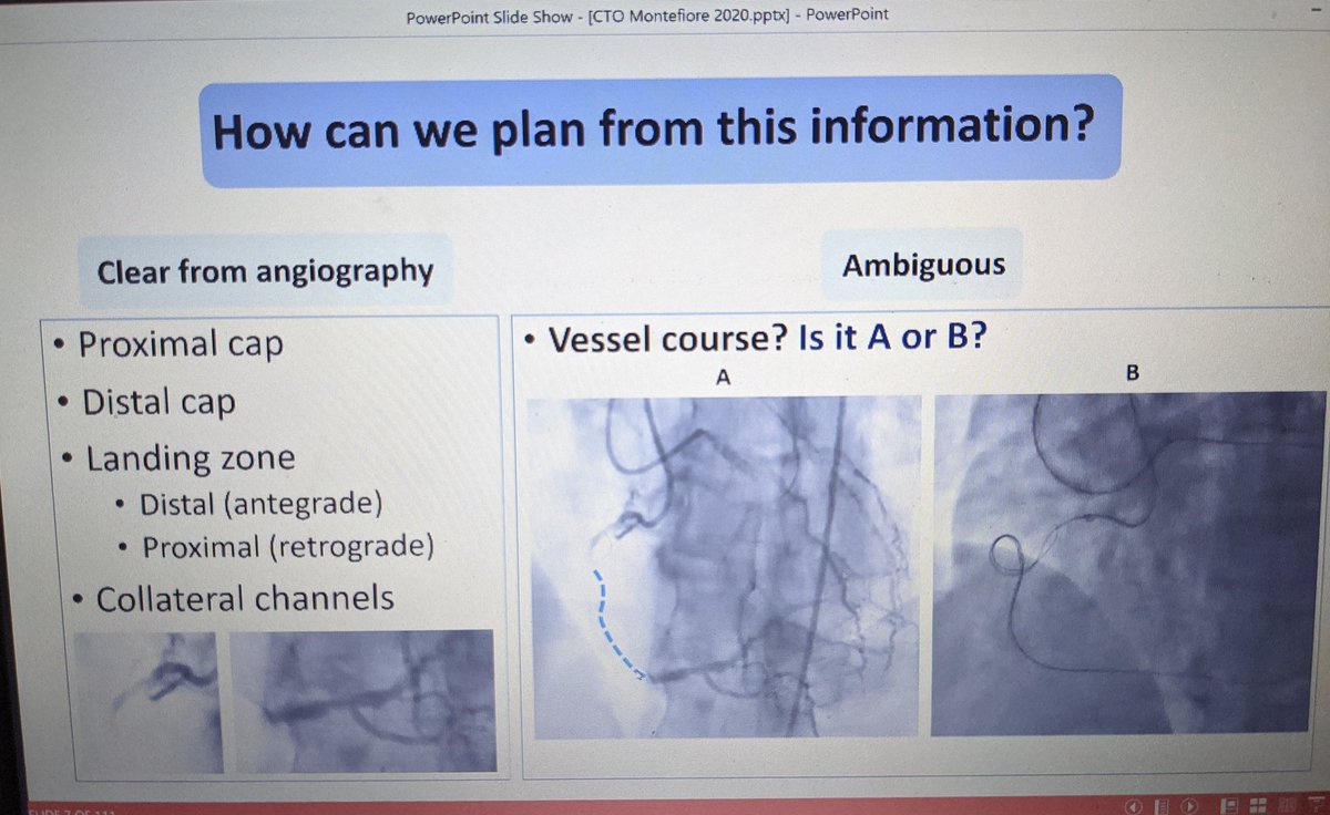 One of the most comprehensive #CTO talks by Dr @fhellig Love this 'Big 5' analogy 🎯when to start: prox cap 🎯Where to go:vessel course 🎯Where to end up:distal cap 🎯 Length (>30mm?) 🎯What route?luminal/subintimal? @yaqoub_lina @atunuguntla1 @tonyhvo @mirvatalasnag @Tabaza