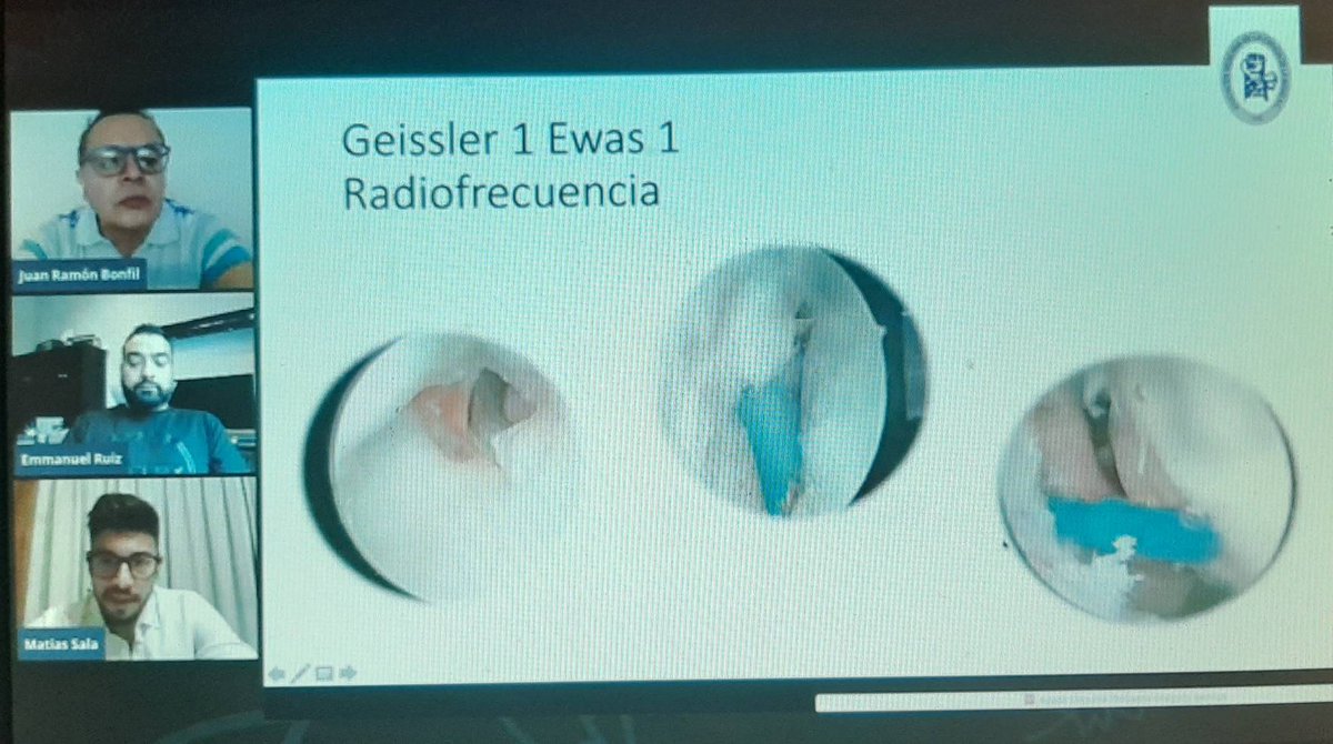 CirugiaManoMIMC's tweet photo. Síndrome de Impactación Cubital por el Dr. Emmanuel Ruíz (@ruizhands) y Capsulodesis de Muñeca por el Dr. Matías Sala (@matisala5) por el canal de #YouTube de la Asociación Mexicana de Cirugía de la Mano. Link: https://t.co/AJROlrFiSm https://t.co/vHCIywQhc0