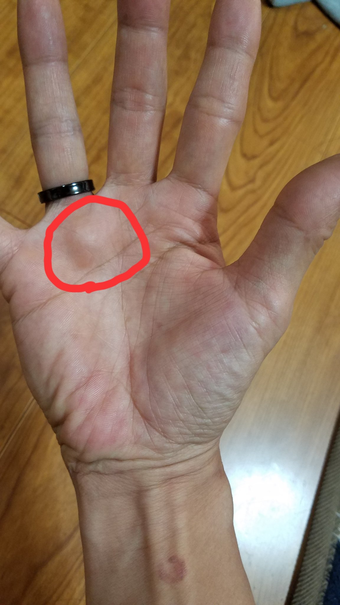 手のひら の しこり