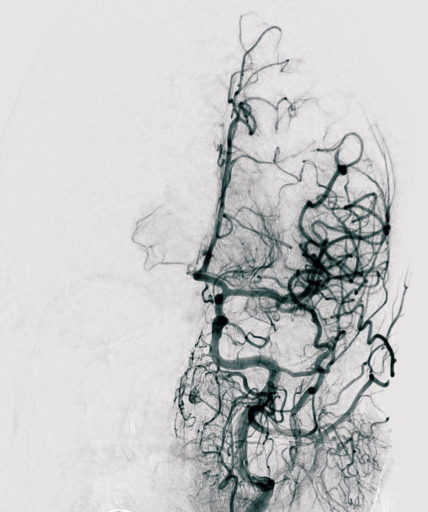 RviTrueta's tweet photo. Combined use of contact aspiration and stent retriever technique in a 45 years female with Left TACI oclusion https://t.co/tnd3ADr4nb