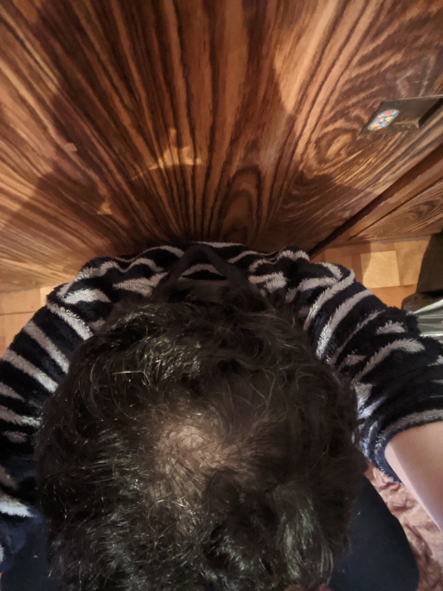 コウメ太夫 左が4月の頭頂部写真 右が6月今日の写真 つむじがだんだん埋まってきてる ᗪクリニック通いって通うほど髪増えるやめられない ウレチ 中京テレビ 薄毛芸人発毛プロジェクト Dクリニック Aga