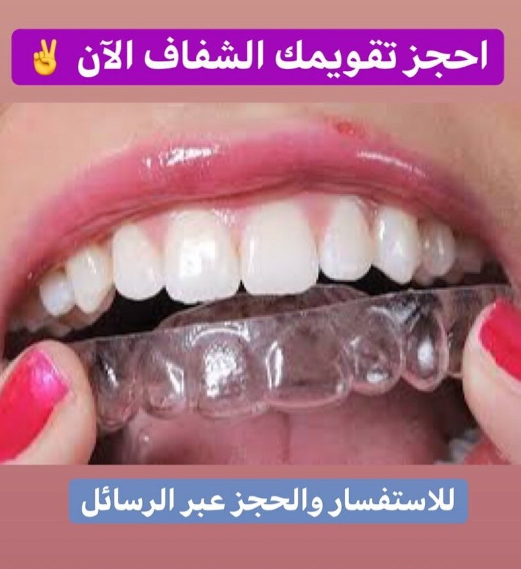 Почему зубы прозрачные. Тетрациклиновые зубы отбеливание. Почему зубы прозрачные. Прозрачные кончики зубов. Почему зубы прозрачные.