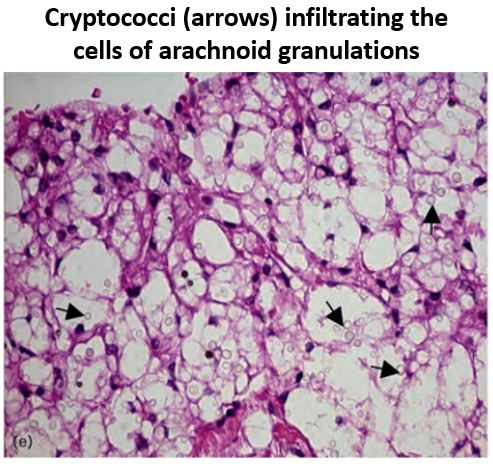 9/To find out what that "something" is, let's examine the arachnoid granulations histologically:There were 2 notable findings w/ cryp. meningitis:- Cryptococci infiltrated the granulations- Vesicles and vacuoles were full of fungi (instead of CSF) https://pubmed.ncbi.nlm.nih.gov/19952714/ 