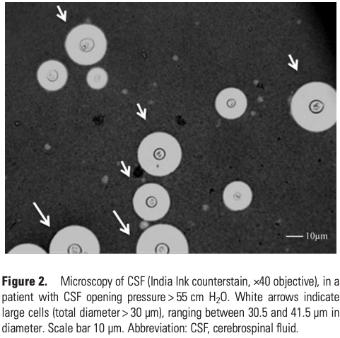 12/But even more fascinating, cryptococcus has a distinctive polysaccharide capsule that contributes to its size and virulence.(Quick aside: shed capsule = the cryptococcal antigen that we test for clinically!) https://pubmed.ncbi.nlm.nih.gov/23945372/ 