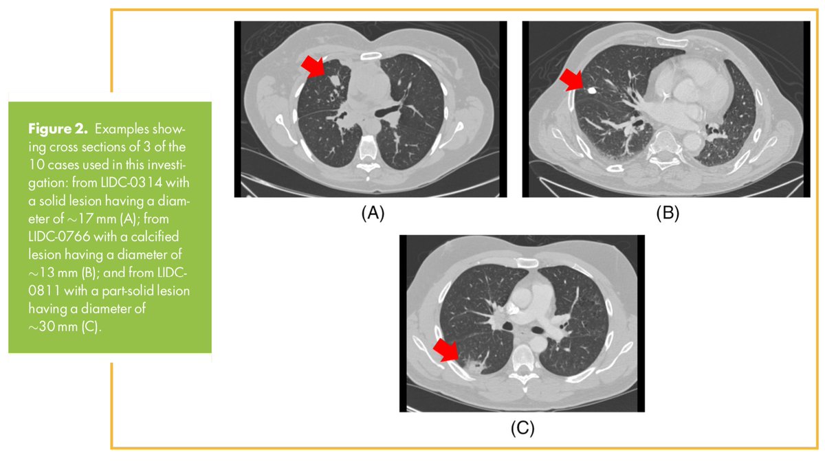 Our multi-center #radiomics feature standardization paper in #Tomography is out:
tomography.org/volume-6/issue…
In this effort within the #NIH quantitative imaging network (#QIN), we used our publicly available radiomics software package SERA:
qurit.ca/software/sera/